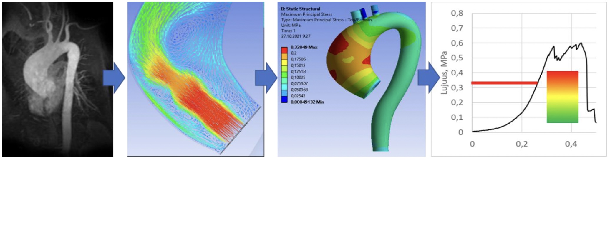 KUVA  1. Tieteelliset tuloksemme osoittavat aortan seinämän rasituksen olevan mitattavissa ja sen perusteella on mahdollista määrittää aortan seinämän repeämispiste. A. CorFlux-analyysin lähtödatana hyödynnetään MK-tai TT-laitteiston dataa, potilaan verenpainetietoja, perinnöllisiä tekijöitä ja elämäntapoja. B. Aortasta tehdään digitaalinen kaksonen tietokonepohjaisella 3D-mallinnuksella. C. Potilaan aortan seinämän rasitus ja elastisuus mitataan ja määritetään aortan seinämän repeämispiste. D. Potilaat ryhmitellään analyysin tuloksen perusteella riskiluokkiin.